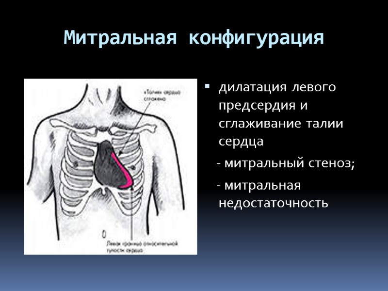 Митральная конфигурация дилатация левого предсердия и сглаживание талии сердца     -